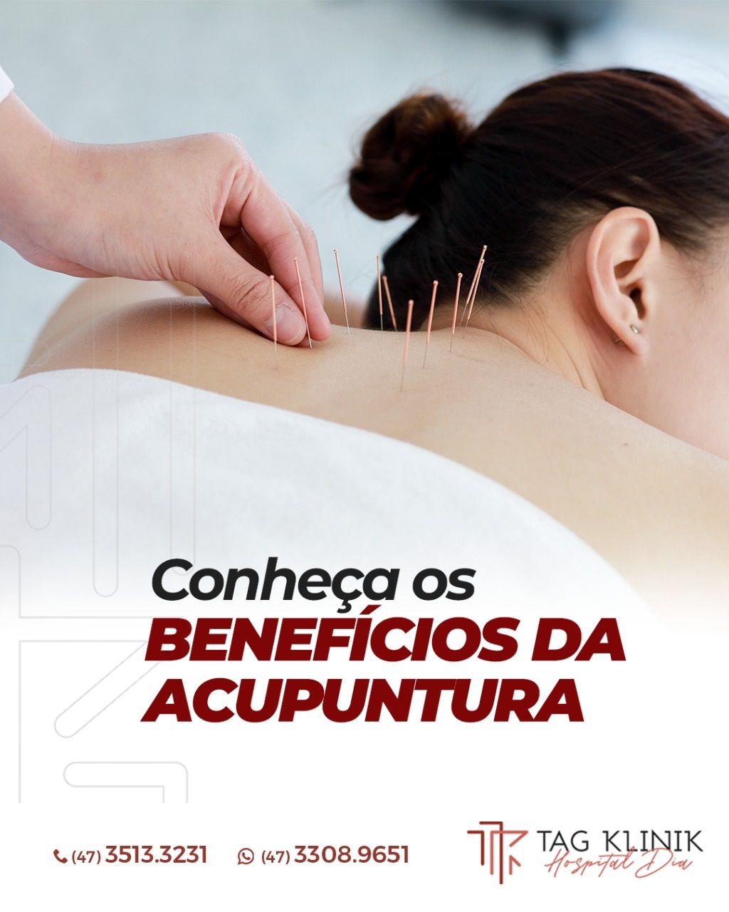acupultura