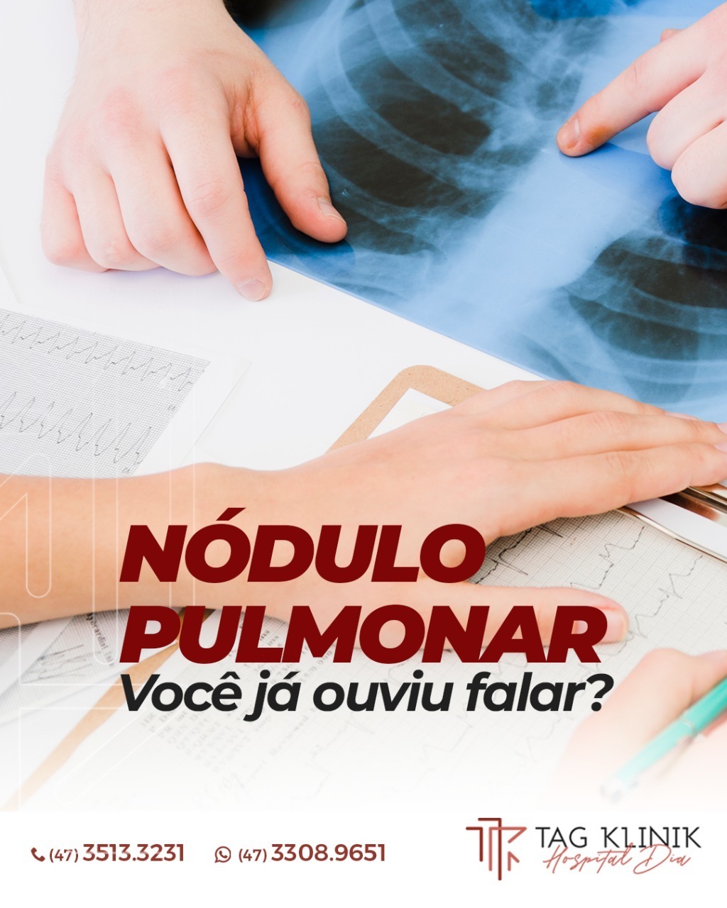 Nódulo Pulmonar