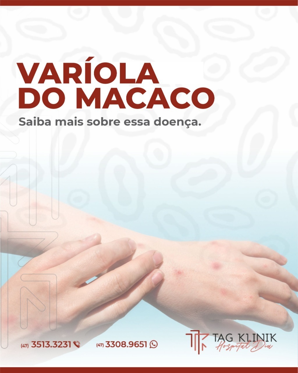 Varíola do Macaco