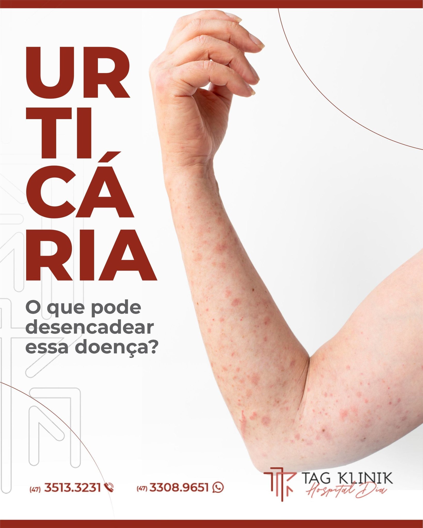 Urticária: tudo o que você precisa saber.