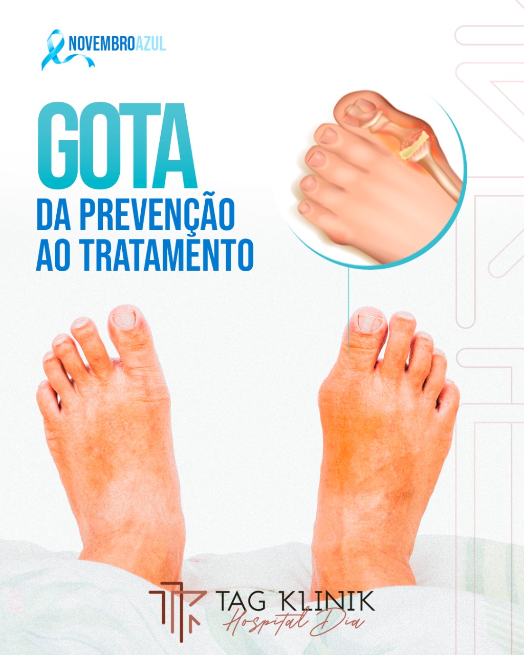 Gota: tudo o que você precisa saber.