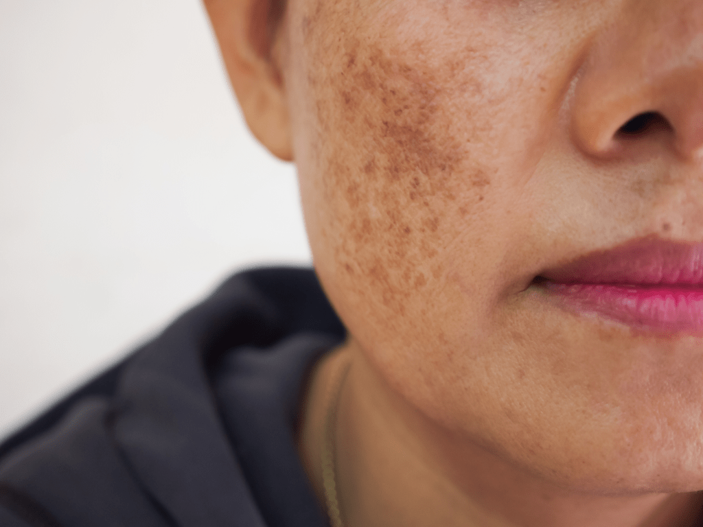 Melasma: Quais as principais causas?