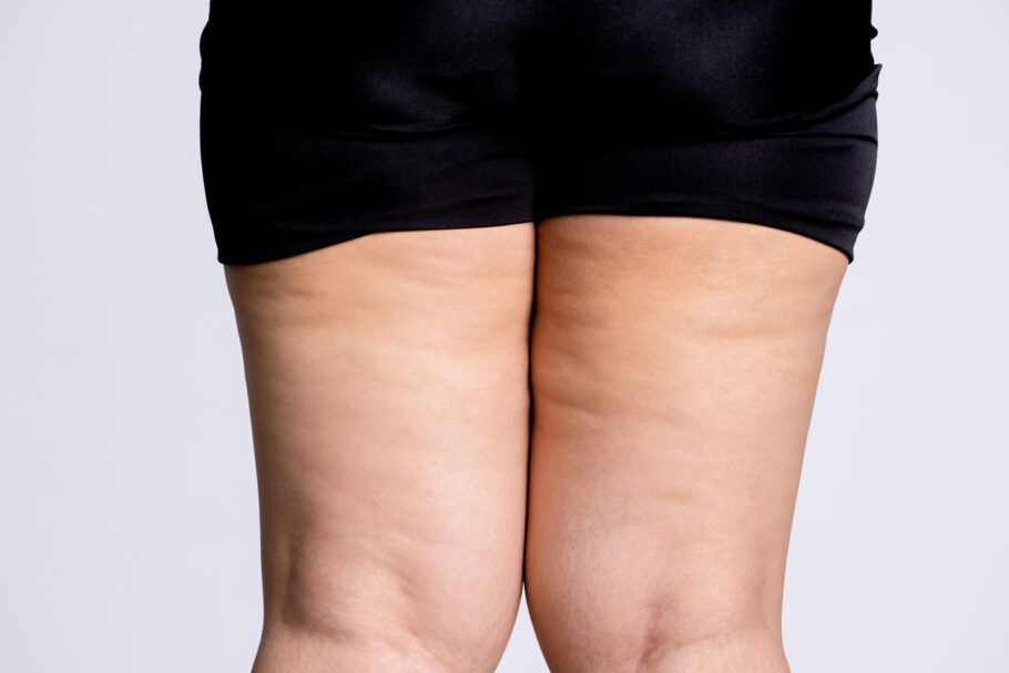 lipedema-910×607